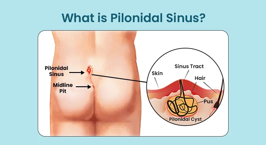 What is Pilonidal Sinus?